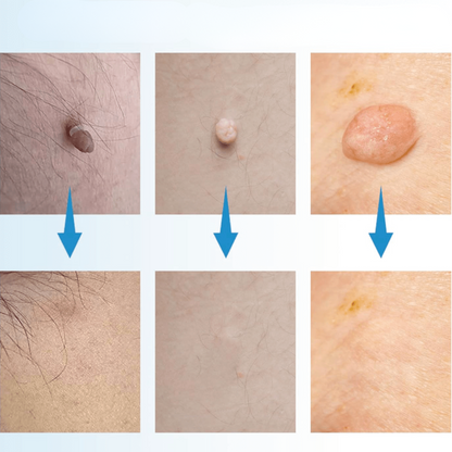 VerrueStop Éliminateur d’acrochordons